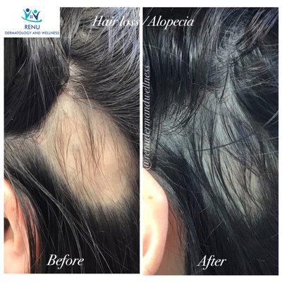 Hair loss/ Alopecia treatment! Improvement seen after just one treatment!