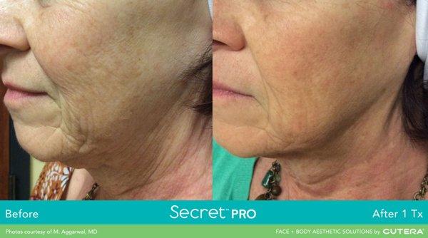 Secret RF - Before & After (Fine lines and wrinkles, skin tightening)