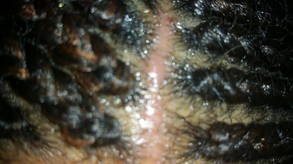 My hair was braided exactly 7 days ago. I am having to apply neosporin and topical pain spray to my part daily for the pain.