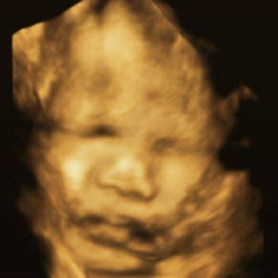 3D/4D ultrasound