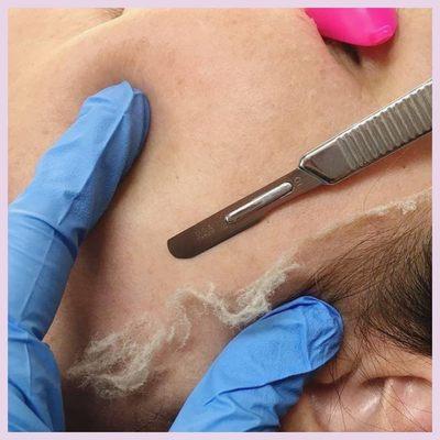 Dermaplaning