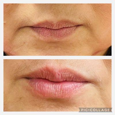 Juvederm before and after