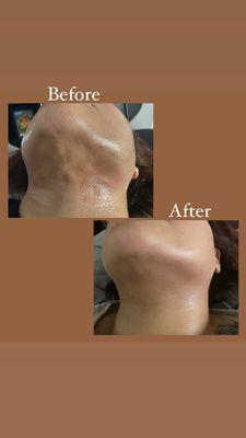 Chin Lipo! Before and After 
Chin Lymphatic Massage