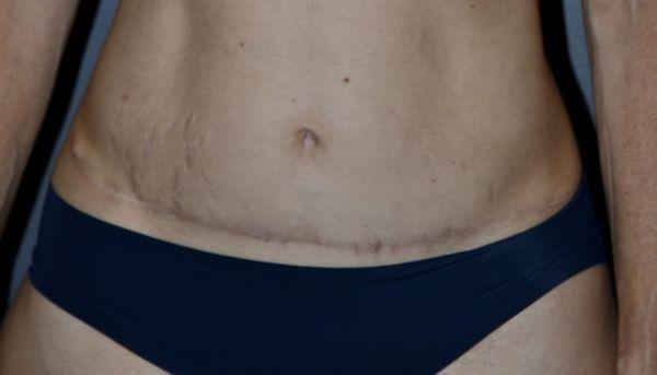 BEFORE: Scar that Dr.Bartlett was hired to revise and improve.