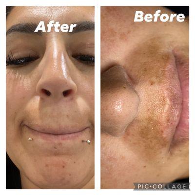 Chemical peel Depigmentation.