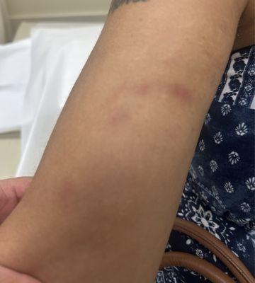 Bruises she received from being pushed and grabbed