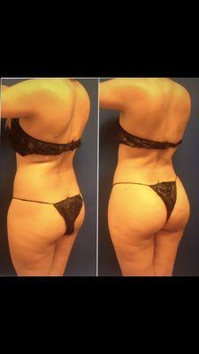 BBL gluteal fat transfer