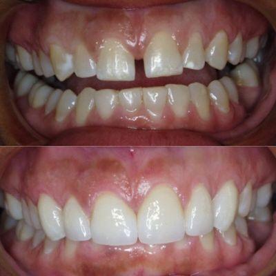 Close a space instantly with veneers.