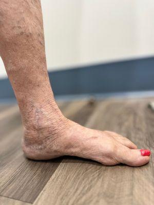 Varicose veins may appear as vascular congestion which is a sign of increased pressure pressure