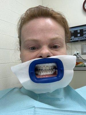 My gums are being prepped for Zoom whitening 8-14-2019