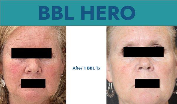 BBL HERO Facial treatment