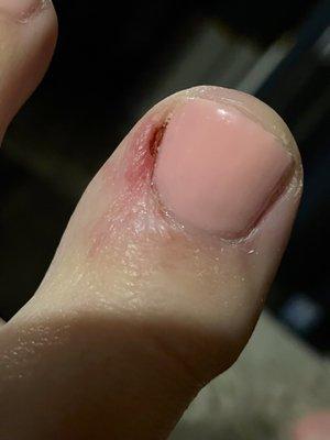 Injury sustained during pedicure