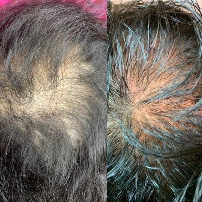 Scalp Micro-pigmentation results after 2 sessions!