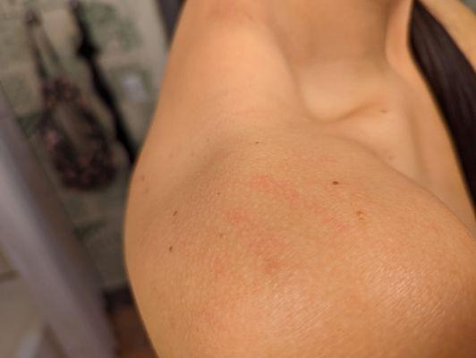 Scratches on my shoulder 6 hours post uncomfortable massage.