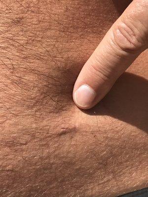 right abdominal incision 23 days after surgery