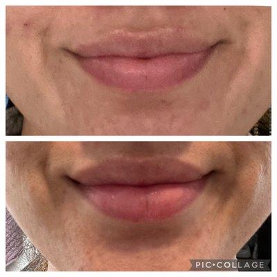 Lip flip results after 5 days