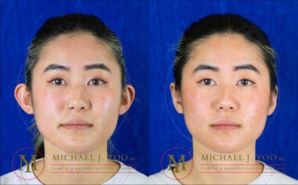 Otoplasty 'aka' Ear Pinning Surgery by Dr. Michael J. Yoo MD - Double Board Certified Plastic Surgeon