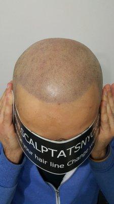 lAfter Scalp tats.