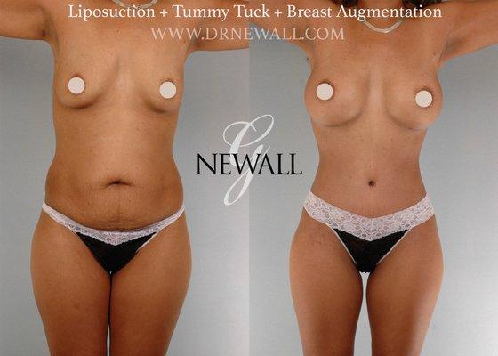 Award-winning case has gained national and international attention. Dr. Newall won the "Best Clinical Case in Surgical Body Shaping"