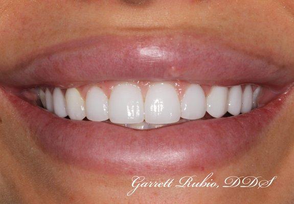 Dr. Rubio's specialty training in Cosmetic Dentistry enables him to deliver these amazing results through conservative porcelain veneers!