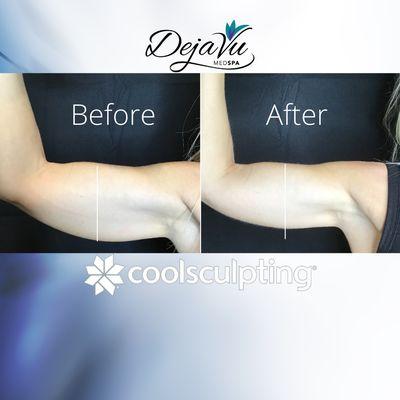 CoolSculpting Before And After