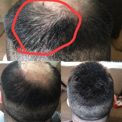 Scalp micropigmentation top before left after. Right with non surgical hair replacement.