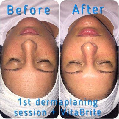 More hydrated, glowing skin. Rejuvenated and refreshed. Dermaplaning and vita brite facial.