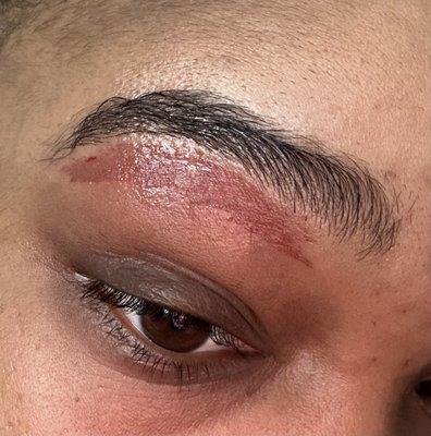 Burn after horrible eyebrow wax