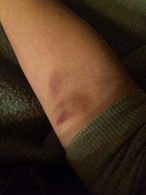 I got this bruises from the blood test done by the Dr ... :(