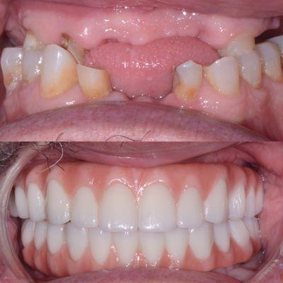 Upper and lower All on 4 for terminal dentition