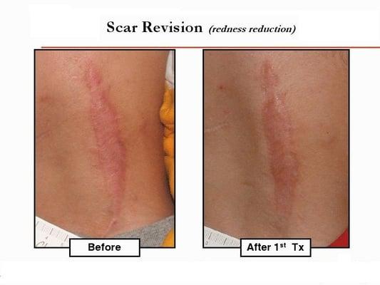 Scar Revision