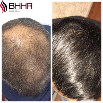 Male hair restoration