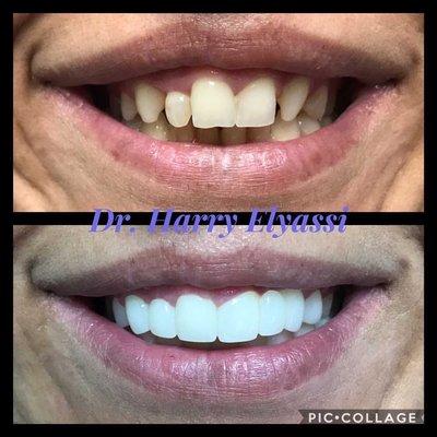 Cosmetic dentistry, crowns