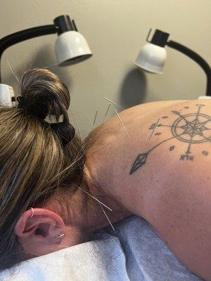 Acupuncture treatment