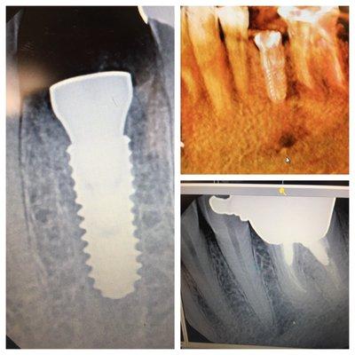 Nonrestorable tooth replaced with implant