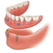 Implants to hold loose dentures