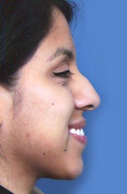 Before Rhinoplasty