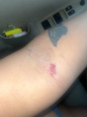 Bruising from where she ripped out Iv