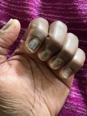 My nails after  the nails got off I got a fungus infection, I have to take antibiotics for 6 weeks