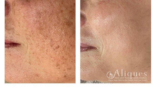 Results after one IPL Photofacial...#aliquesglow call today!