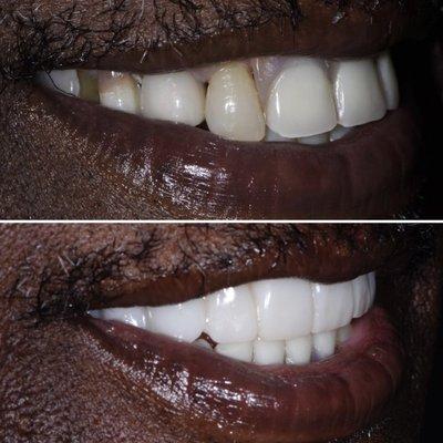 Replacing a removable partial denture with a permanent bridge. The lower photo is the temporary bridge made by Dr. Tatevik Pilosyan.