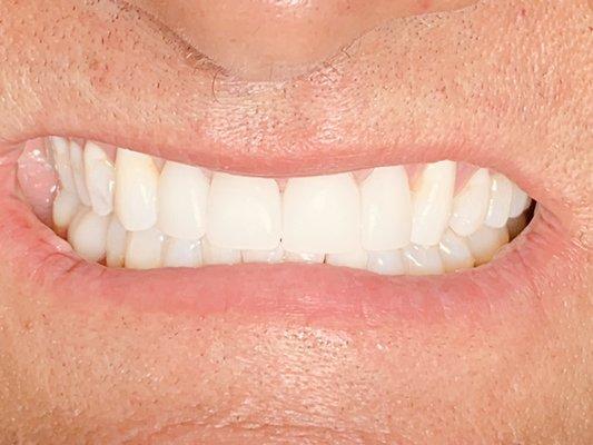 Same Day crowns upper front four teeth! Cerec cosmetic crowns!