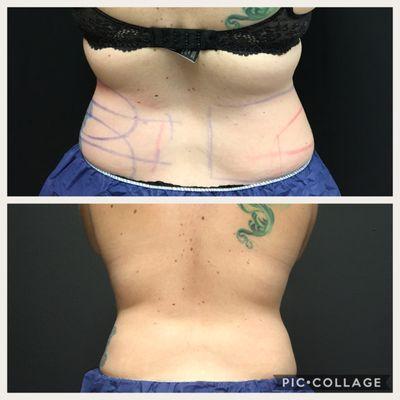 CoolSculpting Before and After