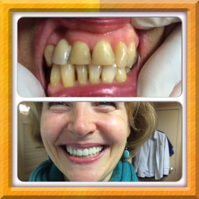 Before (top) and After (bottom) using Cosmetic Porcelain Veneers