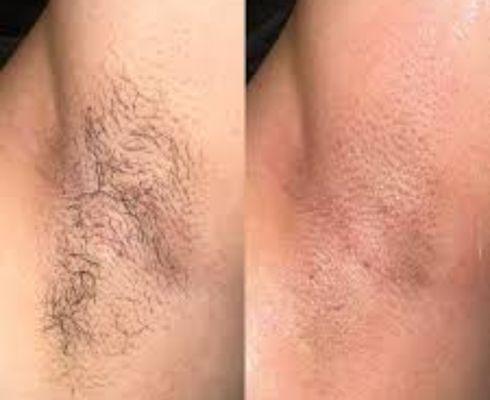 Before and after underarm wax