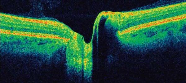 Advanced imaging of the retina and optic nerve