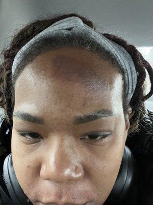 Burn and problematic hairline