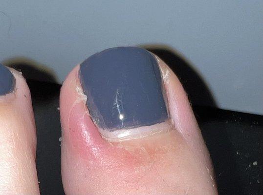 Infected toe. Very very painful