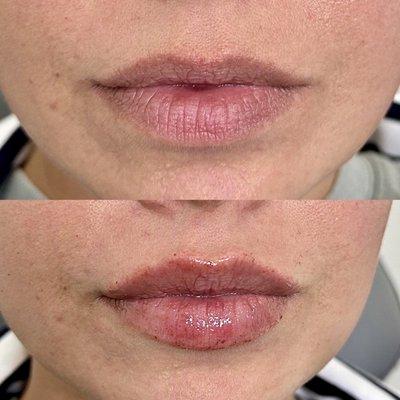 Amazing lip transformation. Juvederm Ultra 1 Syringe.  Hydrated, plump, and natural looking lips.