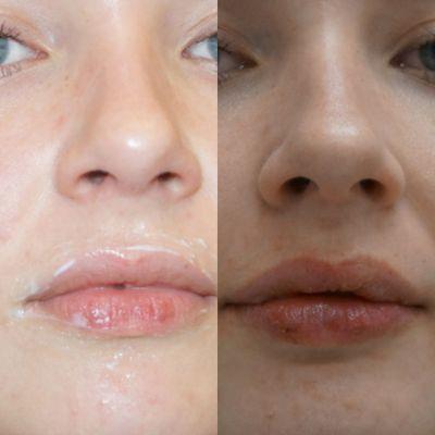 This is the before and after of the so called "Botched" restylane taken in our office.